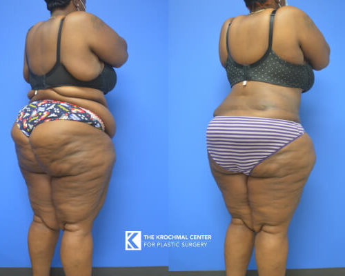 Bra Line Backlift Photos in Chicago with Dr. Krochmal