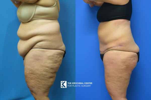 Chicago Tummy Tuck Before & After  Abdominoplasty Surgery Photos