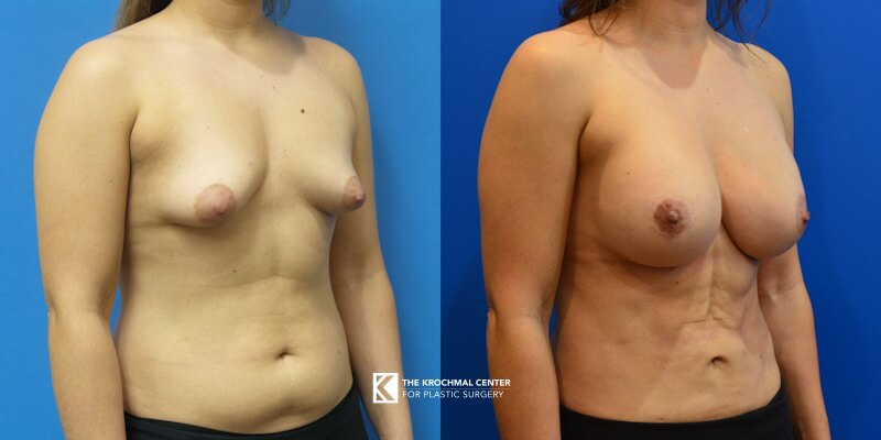 Beautiful breast augmentation with breast implants in Chicago, Hinsdale, IL