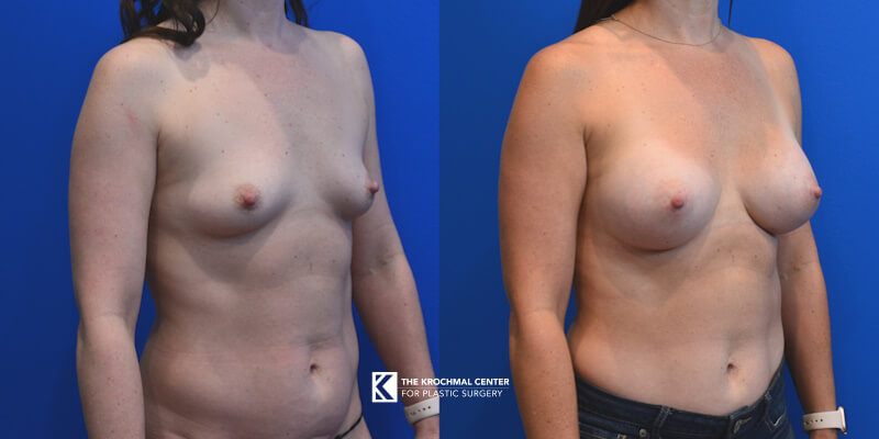 Breast augmentation with implants cosmetic surgery