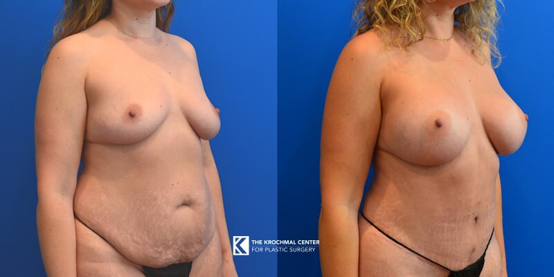 Breast augmentation with implants plastic surgery in Hinsdale in Chicago, Hinsdale, IL