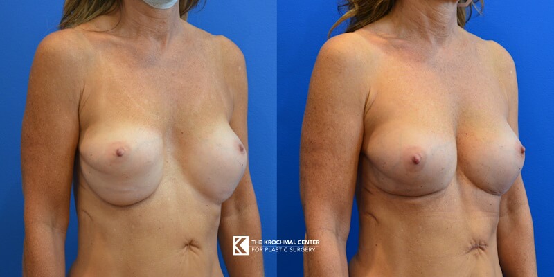 Improving breast appearance after botched breast augmentation