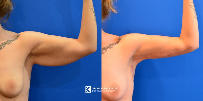 Beautiful arm lift result in Chicago, Hinsdale, IL by Aesthetic Surgeon Daniel Krochmal