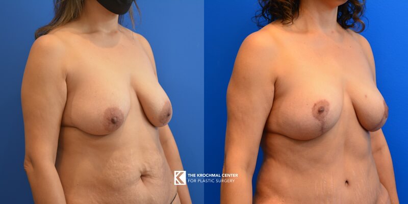 Breast lifting with a mastopexy by Daniel Krochmal