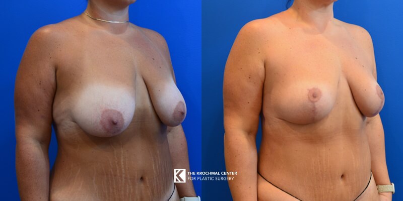 Breast lift results