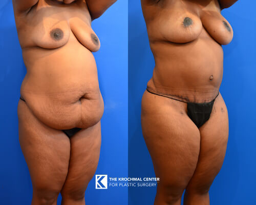 Plus size abdominoplasty for high BMI patients in Chicago, Hinsdale, IL