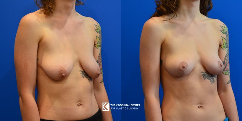 Breast lift mastopexy in in Chicago, Hinsdale, IL results