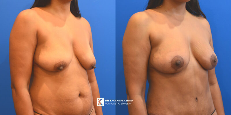 Before and after pics of a beautiful mastopexy breast lift