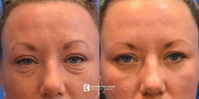 Eyelid lift or blepharoplasty in Chicago, Hinsdale, IL