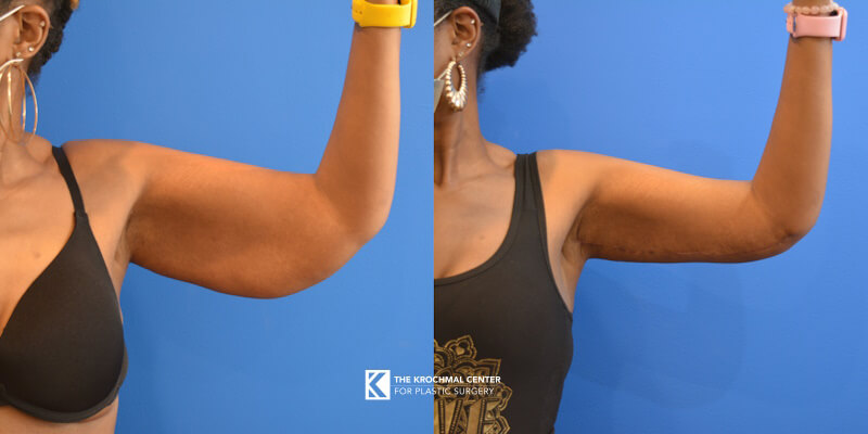 Arm lift brachioplasty result from plastic surgery in Chicago, Hinsdale, IL