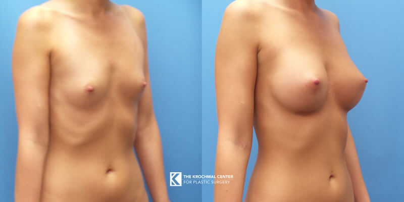 Beautiful breast augmentation with breast implants in Chicago, Hinsdale, IL