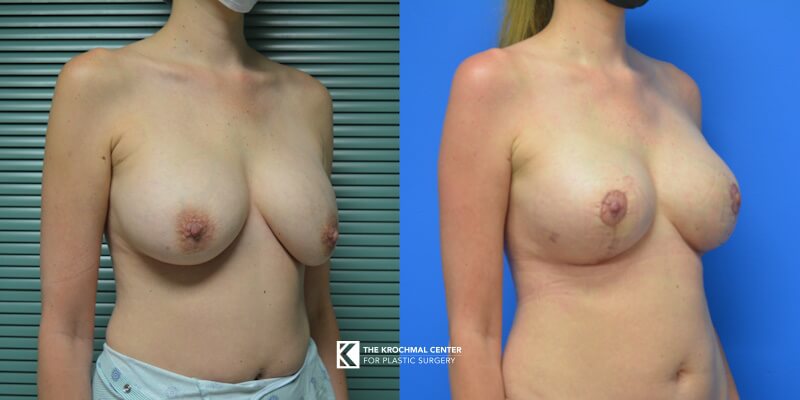 Breast implant exchange with breast lift in Chicago, Hinsdale, IL