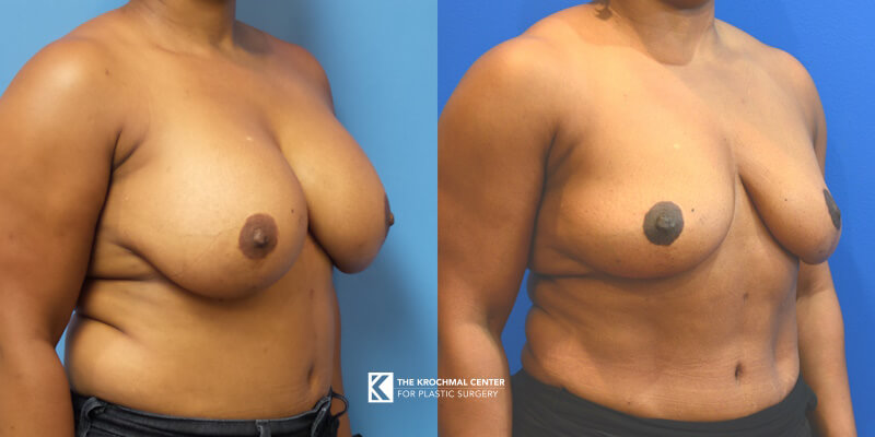 Breast implant removal for BII in Chicago, Hinsdale, IL