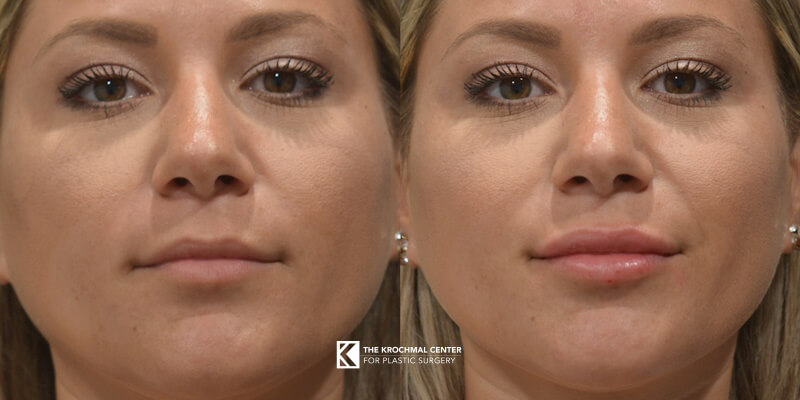 Lip filler result from a master injector in Chicago, Hinsdale, IL