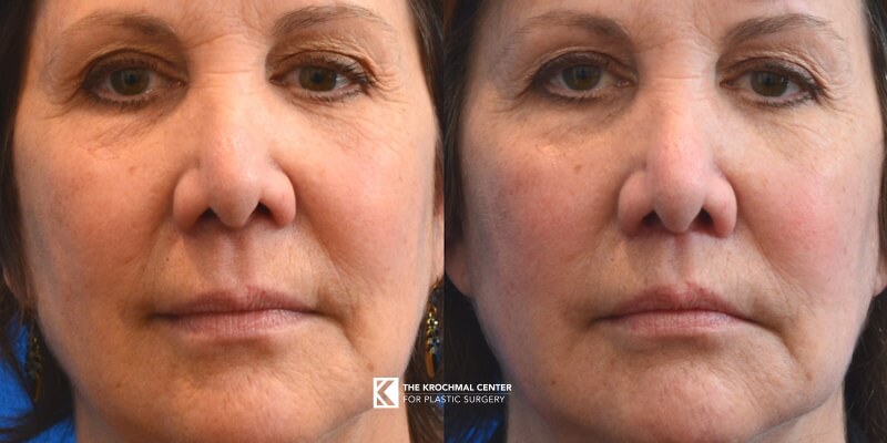 Look younger with a shorter upper lip with a lip lift