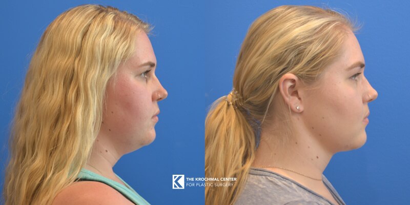 Chin and neck liposuction for double chin and better jawline in Chicago, Hinsdale, IL