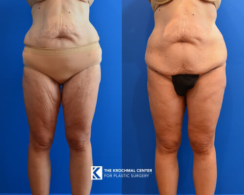 Thinner thighs with a thigh lift after weight loss photo