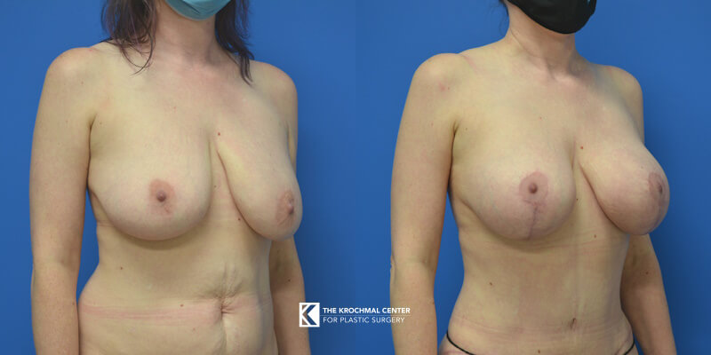 Chicago breast augmentation with lift