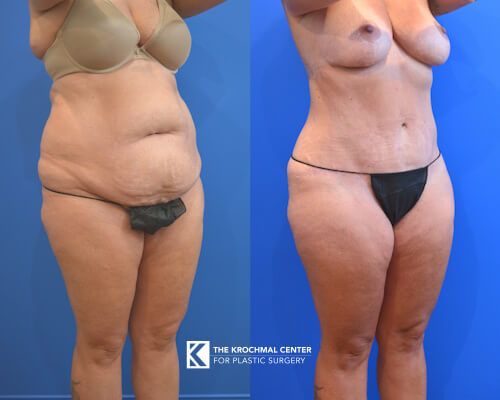 Plastic Surgeon Daniel Krochmal shows a tummy tuck pic to remove extra skin and fat to look snatched in Chicago, Hinsdale, IL