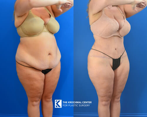 Abdominoplasty Tummy Tuck by Daniel Krochmal in Chicago, Hinsdale, IL