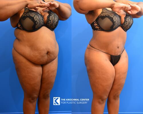 Plus size abdominoplasty with snatched waist in Chicago, Hinsdale, IL