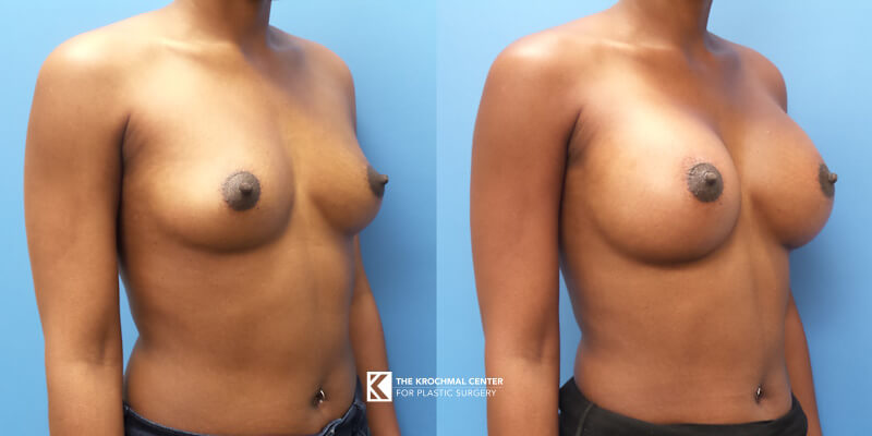 Beautiful breast augmentation with breast implants in Chicago, Hinsdale, IL