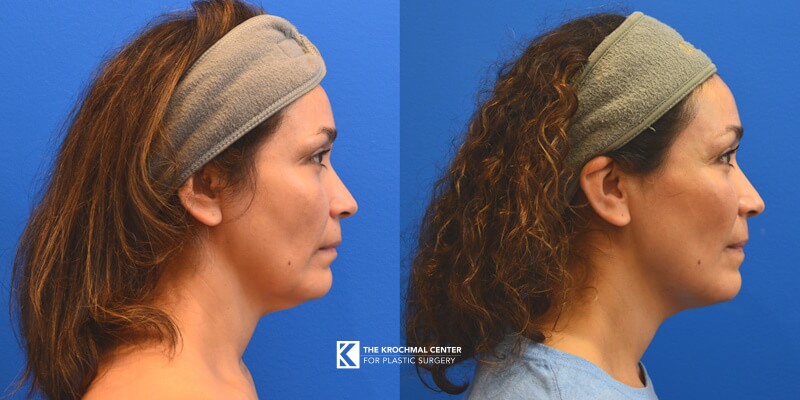 Combine neck liposuction with MyEllevate to create a contoured neck and jawline in Chicago, Hinsdale, IL