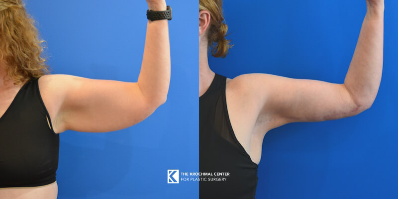 Arm lift brachioplasty result from plastic surgery in Chicago, Hinsdale, IL