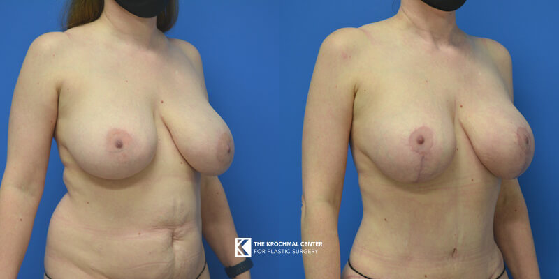 Breast Implant Exchange with Internal Bra and Mastopexy in Chicago, Hinsdale, IL