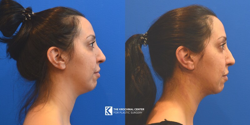 Do neck liposuction with MyEllevate to contour your neck near me in Chicago, Hinsdale, IL