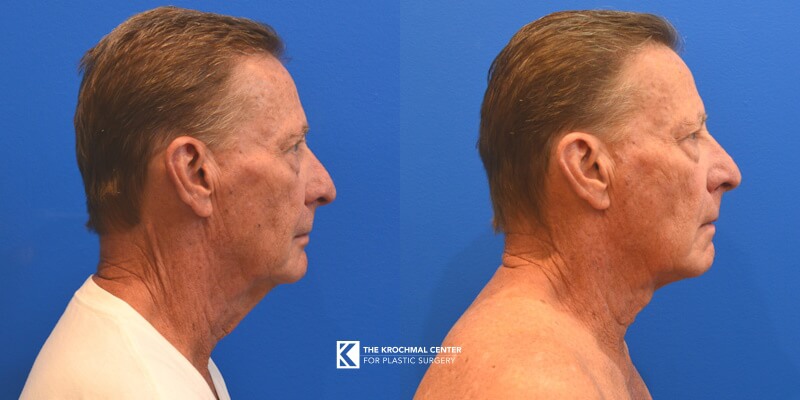 Neck lift procedure in Chicago, Hinsdale, IL