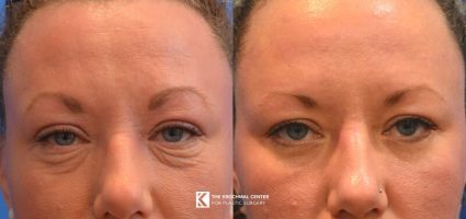 Eyelid lift or blepharoplasty near Burr Ridge Illinois