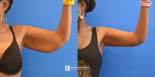 Arm lift brachioplasty result from plastic surgery near me in Wheaton Illinois