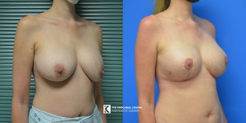 Breast implant exchange with breast lift near Aurora Illinois