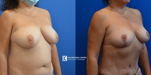 Breast reduction result near Hinsdale for neck and back pain