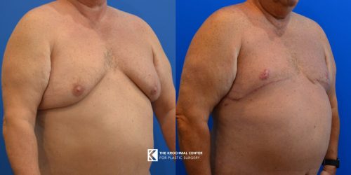 1 Gynecomastia- Man Boobs Naperville Illinois