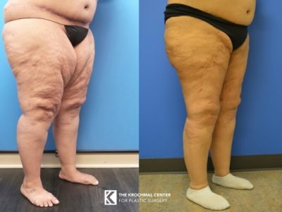 Mega Liposuction Before & After - Explore Our Procedures