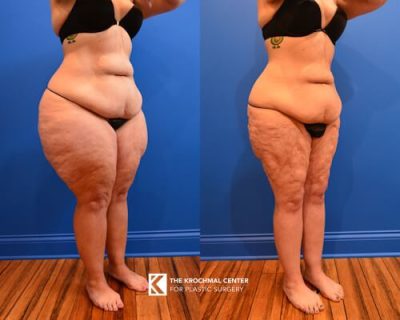 1 Lipedema Liposuction by expert plastic surgeon