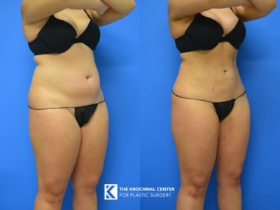 1 Liposuction- near Wheaton Illinois