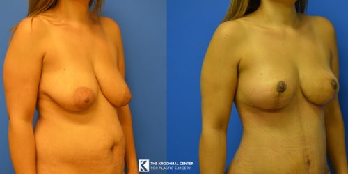 Cosmetic Surgeon Chicago Breast Lift