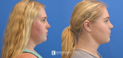 Chin and neck liposuction for double chin and better jawline near Lombard Illinois