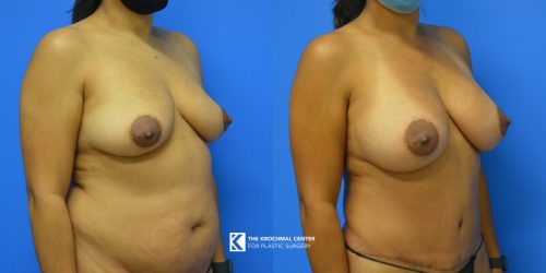 Chicago Breast Augmentation