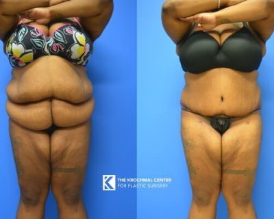 Tummy Tuck in Plus Size