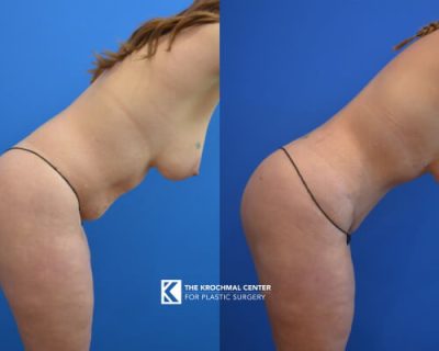 Abdominoplasty with liposuction