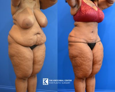 12 Abdominoplasty- plus size patient near Melrose Park