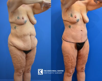 13 Abdominoplasty- near Orland Park Illinois