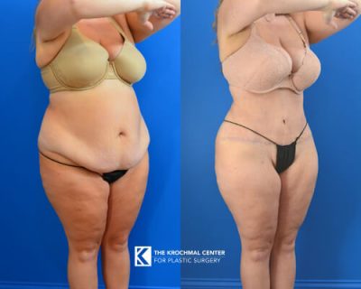 Abdominoplasty Tummy Tuck by Daniel Krochmal near Plainfield Illinois