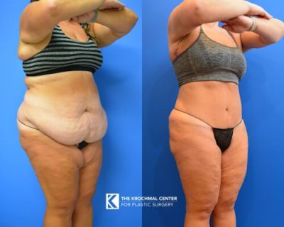 Tummy Tuck surgery near Elgin by Chicago Plastic Surgeon Daniel Krochmal