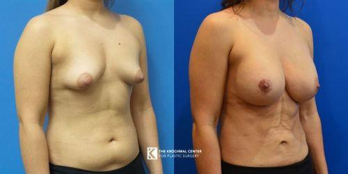 Beautiful breast augmentation with breast implants in Chicago