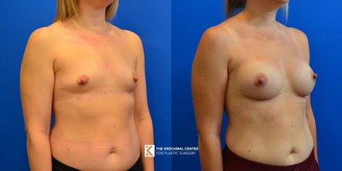 19 Breast Augmentation near Orland Park